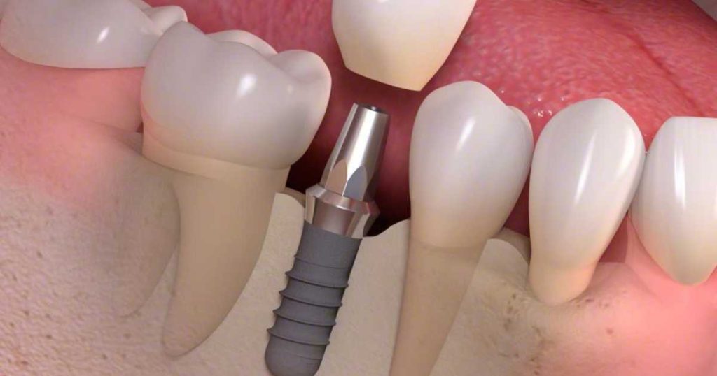 Implante dentário Dr Henrique Souza